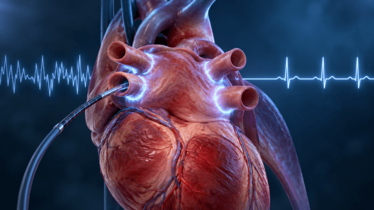A New Way to Fix an Old Heart Problem: What Is Pulsed Field Ablation?