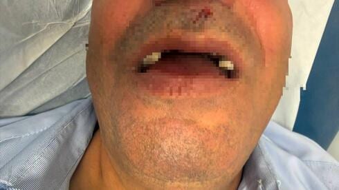 "הרגשתי דם בפה - וראיתי פרצופים מלאי שנאה": נהג אוטובוס הותקף בירושלים